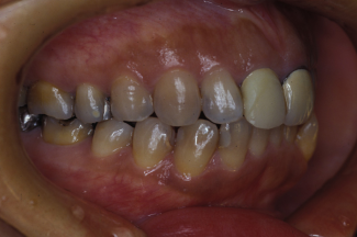 歯の移植の症例