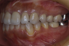 歯の移植の症例