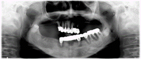 入れ歯治療初診時レントゲン