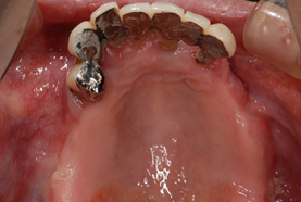 入れ歯治療の症例