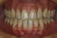 ホワイトニング初診時