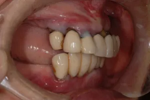 入れ歯治療初診時２